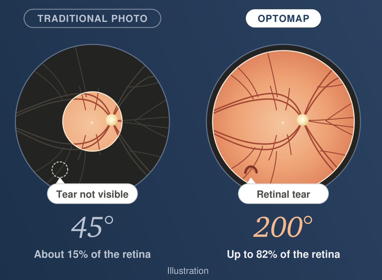 Illustration comparing a traditional 45-degree retinal photo with Optomap’s 200-degree view
